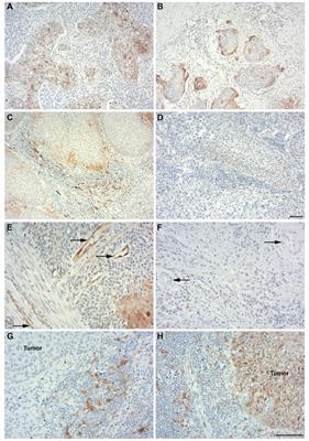 Indoleamine 2,3-Dioxygenase Expression Pattern in the Tumor Microenvironment Predicts Clinical Outcome in Early Stage Cervical Cancer